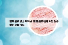 銀屑病皮損分布特點(diǎn) 銀屑病的臨床分型及各型的皮損特征