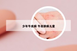 少年牛皮癬 牛皮膚癬兒童