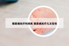銀屑病光療時(shí)間表 銀屑病光療幾次見效