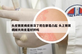 頭皮銀屑病皮損沒(méi)了現(xiàn)在都是凸起 頭上銀屑病掉大塊皮是好轉(zhuǎn)嗎