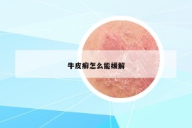 牛皮癬怎么能緩解