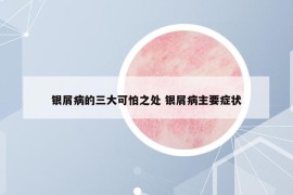 銀屑病的三大可怕之處 銀屑病主要癥狀