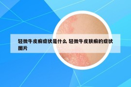 輕微牛皮癬癥狀是什么 輕微牛皮膚癬的癥狀圖片