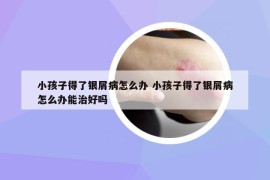 小孩子得了銀屑病怎么辦 小孩子得了銀屑病怎么辦能治好嗎