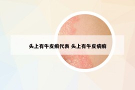 頭上有牛皮癬代表 頭上有牛皮病癬