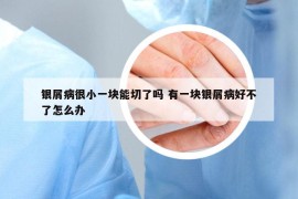 銀屑病很小一塊能切了嗎 有一塊銀屑病好不了怎么辦