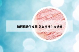 如何根治牛皮蘚 怎么治療牛皮病癬