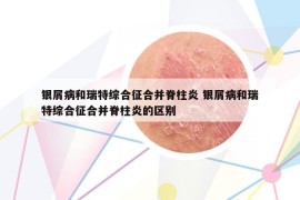 銀屑病和瑞特綜合征合并脊柱炎 銀屑病和瑞特綜合征合并脊柱炎的區(qū)別