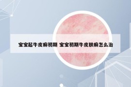 寶寶起牛皮癬初期 寶寶初期牛皮膚癬怎么治