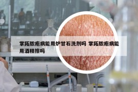 掌跖膿皰病能用爐甘石洗劑嗎 掌跖膿皰病能用酒精擦嗎