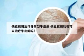 他克莫司治療尋常型牛皮癬 他克莫司軟膏可以治療牛皮癬嗎?