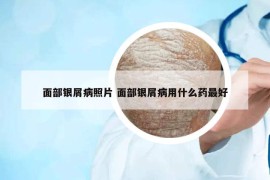 面部銀屑病照片 面部銀屑病用什么藥最好