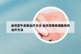 血熱型牛皮癬治療方法 血熱型銀屑病最有效治療方法