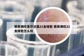 銀屑病吃善存還是21金維他 銀屑病吃21金維他怎么樣