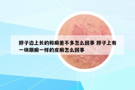 脖子邊上長的和癬差不多怎么回事 脖子上有一塊跟癬一樣的皮癬怎么回事