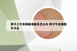 脖子上牛皮癬越來越多怎么辦 脖子牛皮癬圖片大全