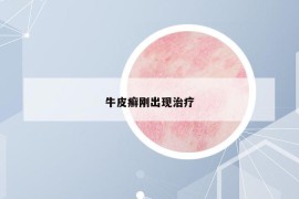 牛皮癬剛出現(xiàn)治療