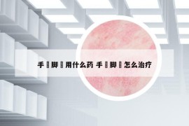 手廯腳廯用什么藥 手廯腳廯怎么治療