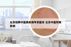 北京招聘中醫(yī)銀屑病專家醫(yī)生 北京中醫(yī)院銀屑病