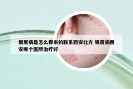 銀屑病是怎么得來的聯(lián)系西安北方 銀屑病西安哪個醫(yī)院治療好