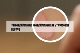 對膿皰型銀屑病 膿皰型銀屑病用了生物制劑能好嗎