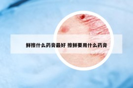 鮮擦什么藥膏最好 擦鮮要用什么藥膏