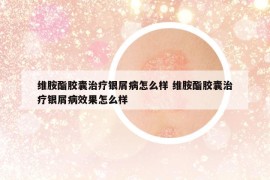 維胺酯膠囊治療銀屑病怎么樣 維胺酯膠囊治療銀屑病效果怎么樣