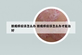 膿皰疹應(yīng)該怎么辦 膿皰疹應(yīng)該怎么辦才能治好