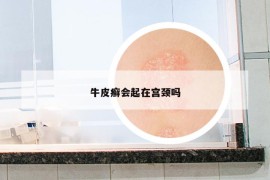 牛皮癬會(huì)起在宮頸嗎