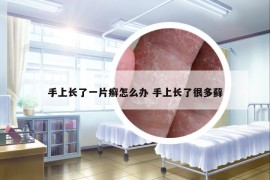 手上長了一片癬怎么辦 手上長了很多蘚