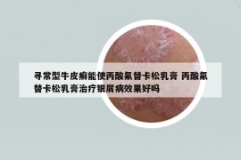 尋常型牛皮癬能使丙酸氟替卡松乳膏 丙酸氟替卡松乳膏治療銀屑病效果好嗎