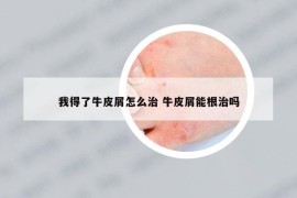 我得了牛皮屑怎么治 牛皮屑能根治嗎