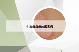 牛皮癬瘙癢的厲害嗎