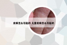 皮癬怎么引起的 兒童皮癬怎么引起的