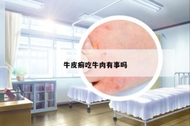 牛皮癬吃牛肉有事嗎