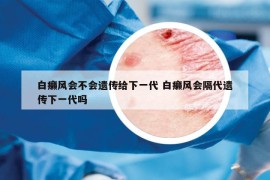 白癩風會不會遺傳給下一代 白癩風會隔代遺傳下一代嗎