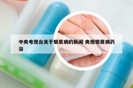 中央電視臺(tái)關(guān)于銀屑病的新聞 央視銀屑病藥浴