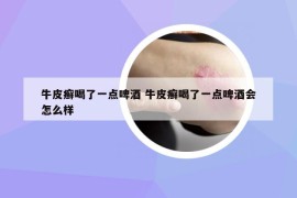 牛皮癬喝了一點(diǎn)啤酒 牛皮癬喝了一點(diǎn)啤酒會(huì)怎么樣