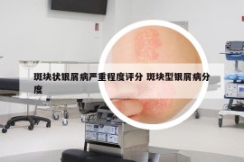 斑塊狀銀屑病嚴(yán)重程度評分 斑塊型銀屑病分度