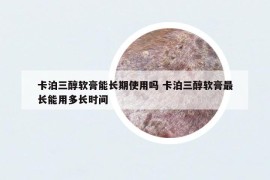 卡泊三醇軟膏能長期使用嗎 卡泊三醇軟膏最長能用多長時(shí)間