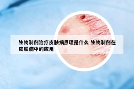 生物制劑治療皮膚病原理是什么 生物制劑在皮膚病中的應(yīng)用