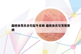 扁桃體發(fā)炎會引起牛皮癬 扁桃體炎引發(fā)銀屑病