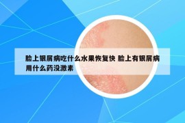 臉上銀屑病吃什么水果恢復快 臉上有銀屑病用什么藥沒激素