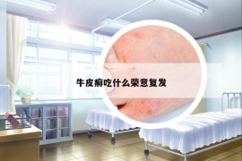 牛皮癬吃什么榮意復(fù)發(fā)