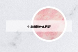 牛皮癬擦什么藥好