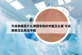 牛皮膚癬是什么原因?qū)е碌闹嗅t(yī)怎么看 牛皮膚癬怎么根治中醫(yī)
