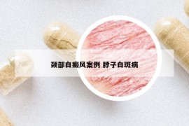 頸部白癜風(fēng)案例 脖子白斑病