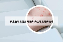 頭上有牛皮屑幾天洗頭 頭上牛皮屑傳染嗎