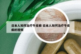 日本人如何治療牛皮癬 日本人如何治療牛皮癬的視頻