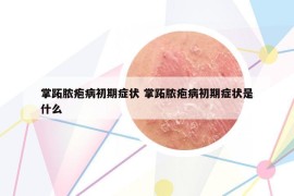 掌跖膿皰病初期癥狀 掌跖膿皰病初期癥狀是什么